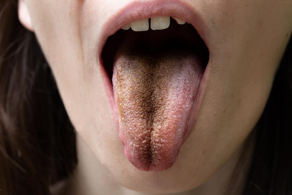 5 Penyebab Lidah Hitam dari Merokok Hingga Mulut Kering