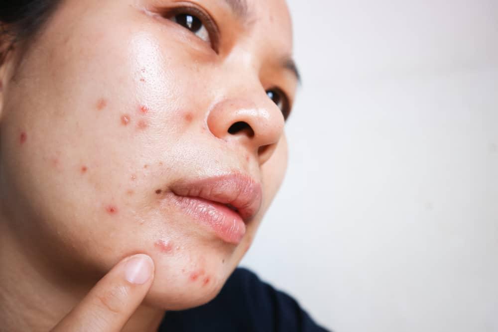 Mengapa Jerawat Selalu Bermunculan Sebelum Menstruasi?
