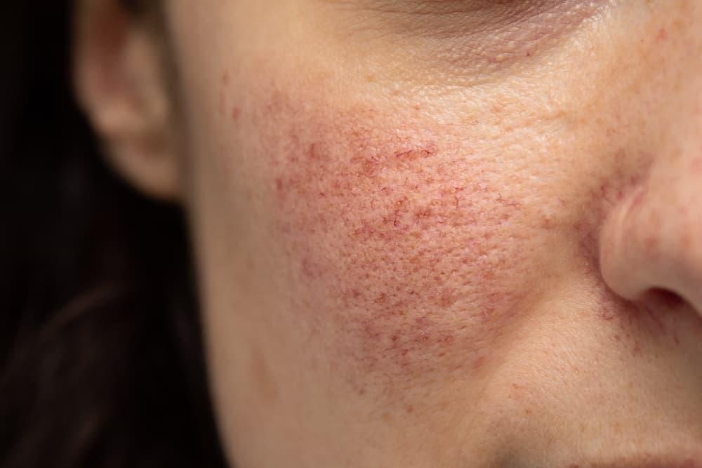 perbedaan-rosacea-dan-jerawat