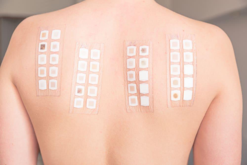 Tes Tempel (Skin Patch Test)
