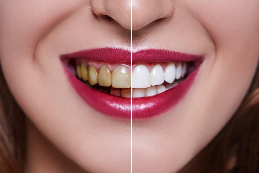 Awetnya Veneer Ternyata Berbeda pada Tiap Orang, Apa Sebabnya?