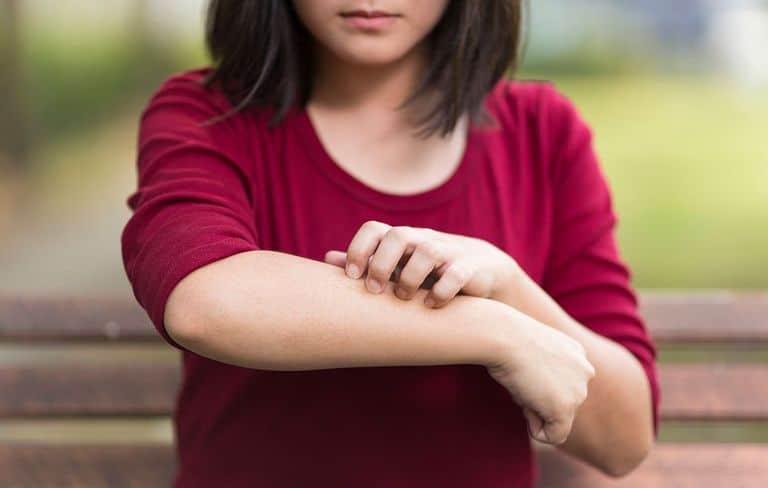 gatal-gigitan-serangga