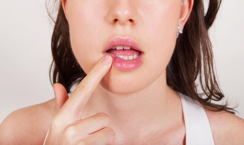 Penyebab Jerawat Muncul di Bibir, Plus Cara Mengatasi dan Mencegahnya