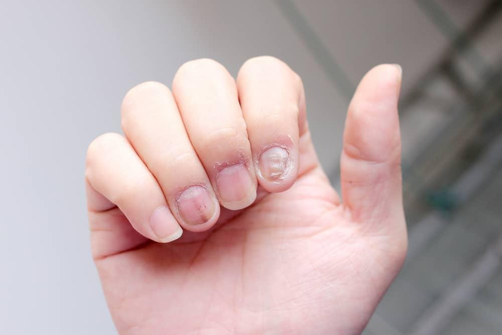 Apakah Psoriasis Kuku Bisa Disembuhkan?