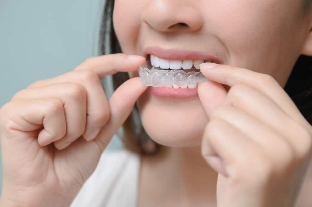 3 Tips Menggunakan Behel Transparan Agar Hasilnya Optimal