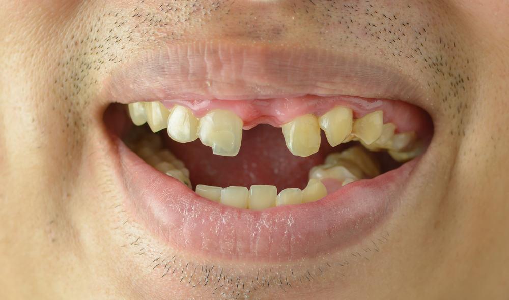 hypodontia-adalah