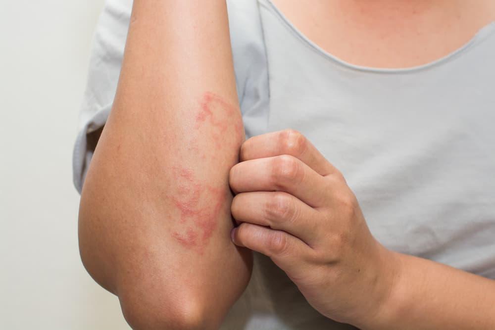 dermatitis-numularis-adalah
