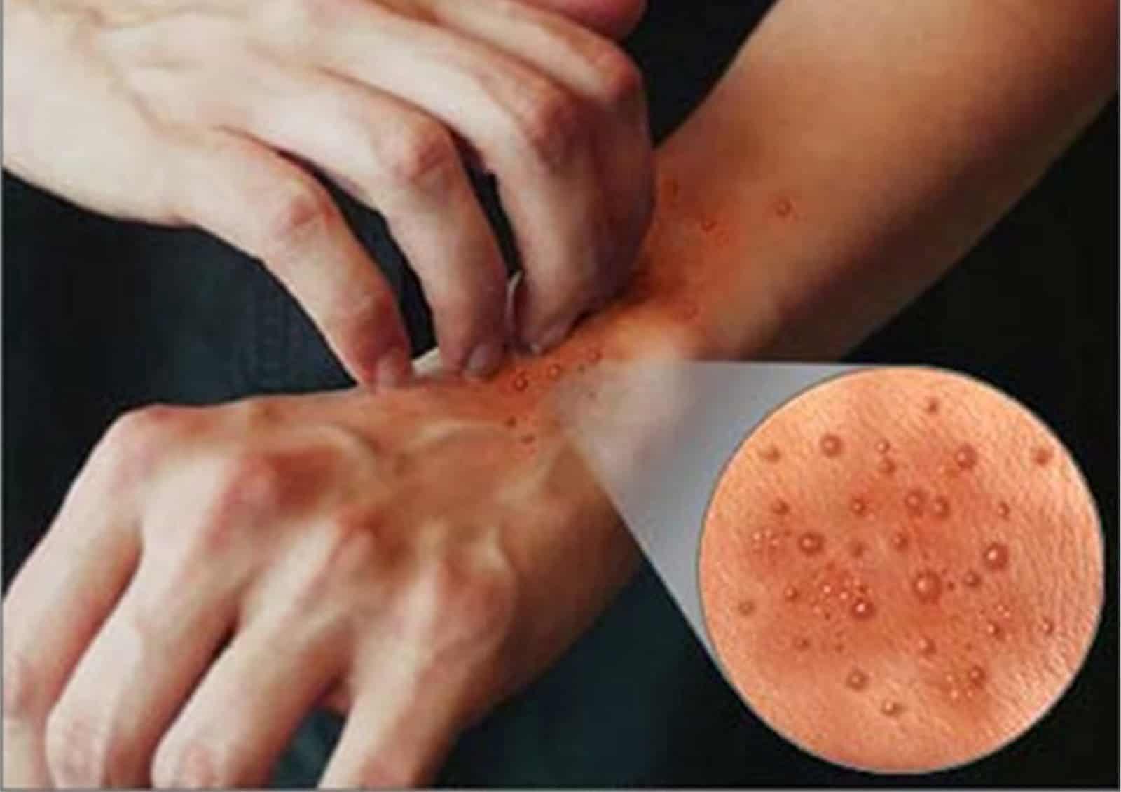 komplikasi-dermatitis