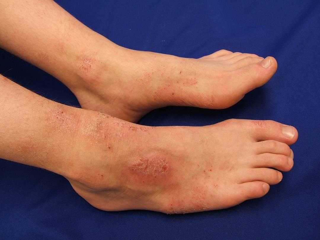 dermatitis-stasis