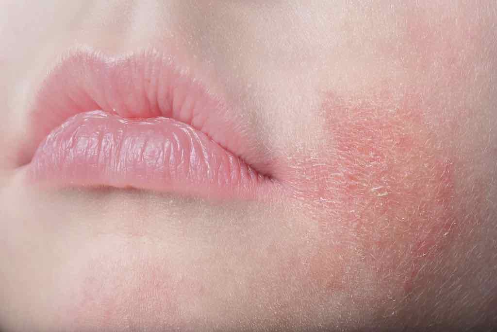 dermatitis-perioral