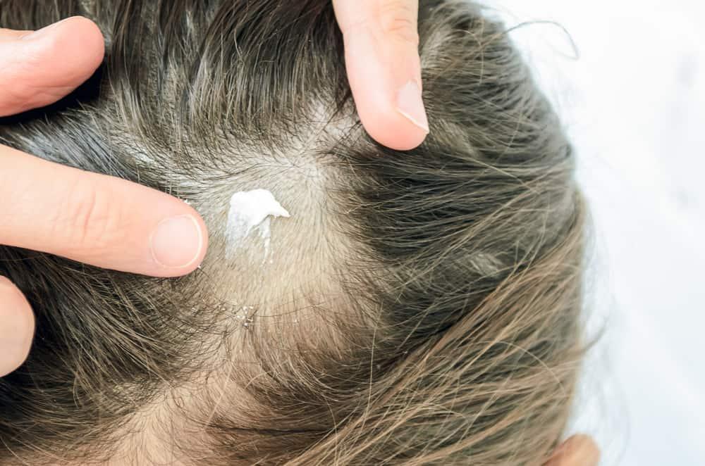obat-dermatitis-seboroik
