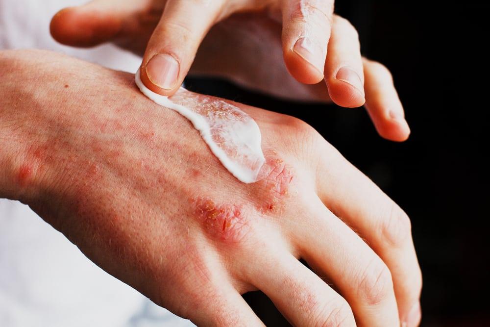 Berbagai Pilihan Salep yang Ampuh untuk Redakan Psoriasis