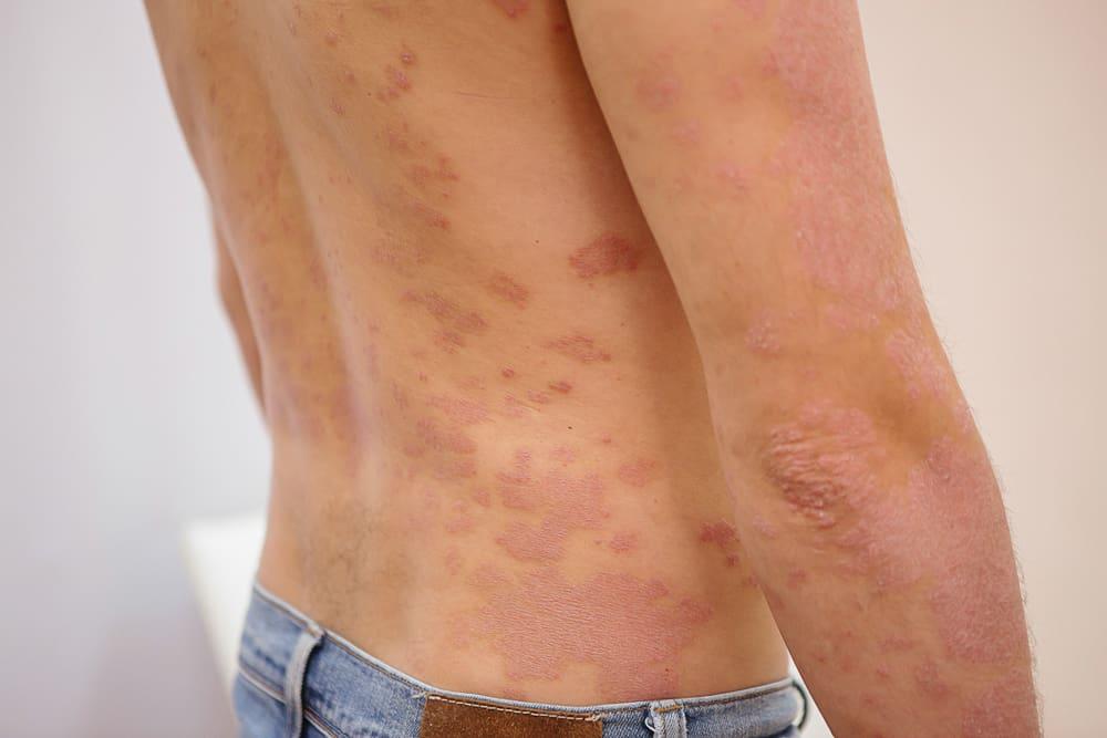 psoriasis-eritroderma