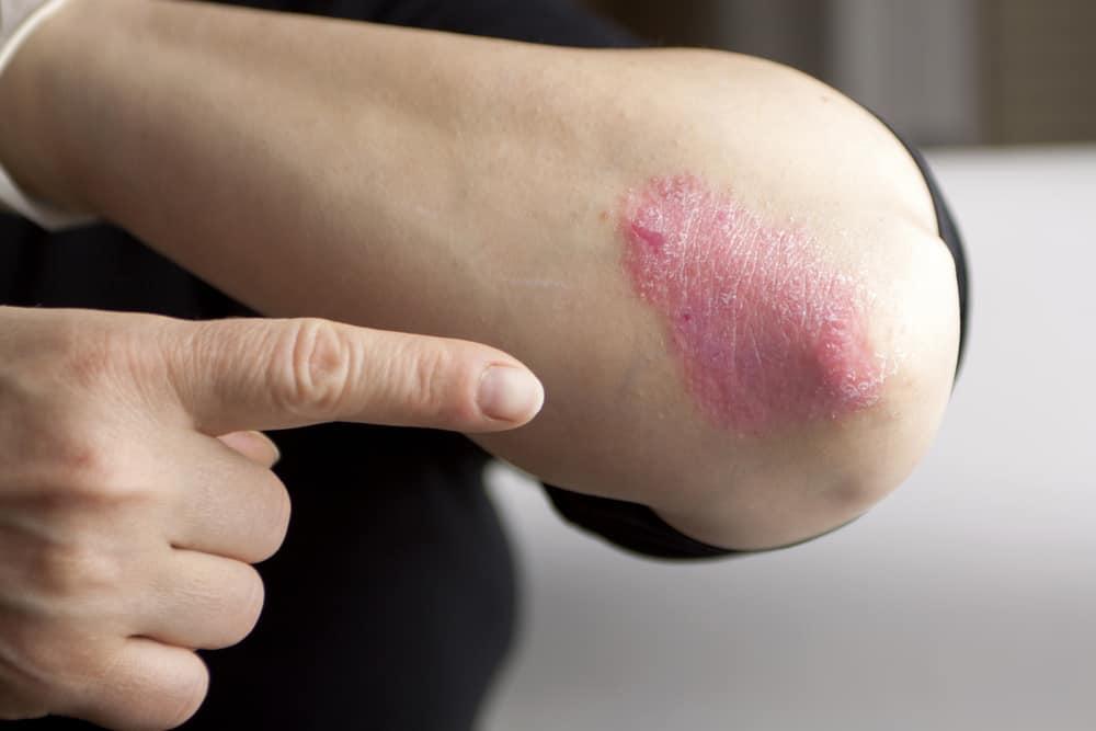 psoriasis-vulgaris