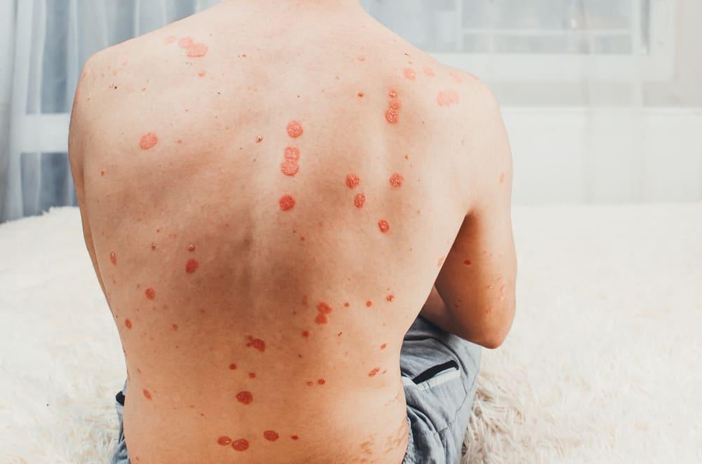 Psoriasis Gutata