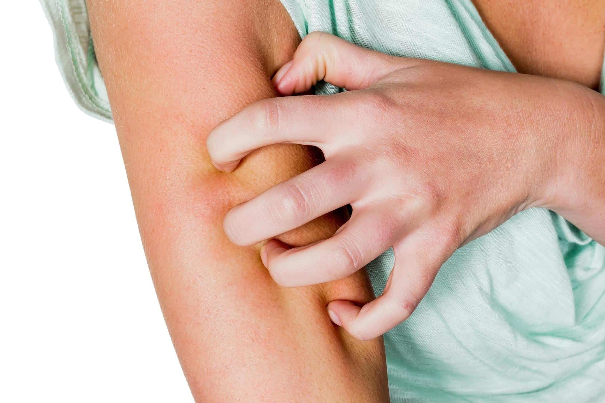 Kudis Api (Norwegian Scabies; Kudis Berkrusta)