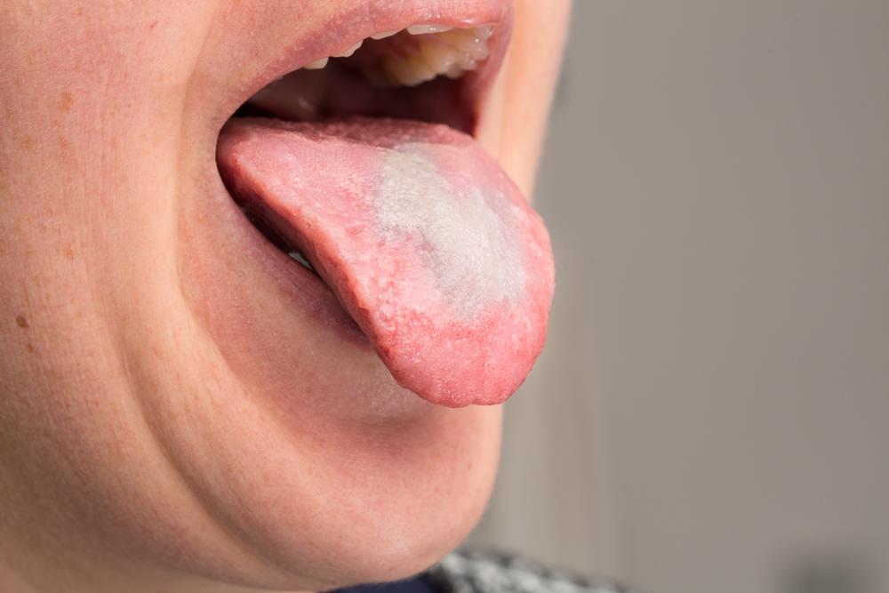 obat-alami-oral-thrush-infeksi-jamur-di-mulut