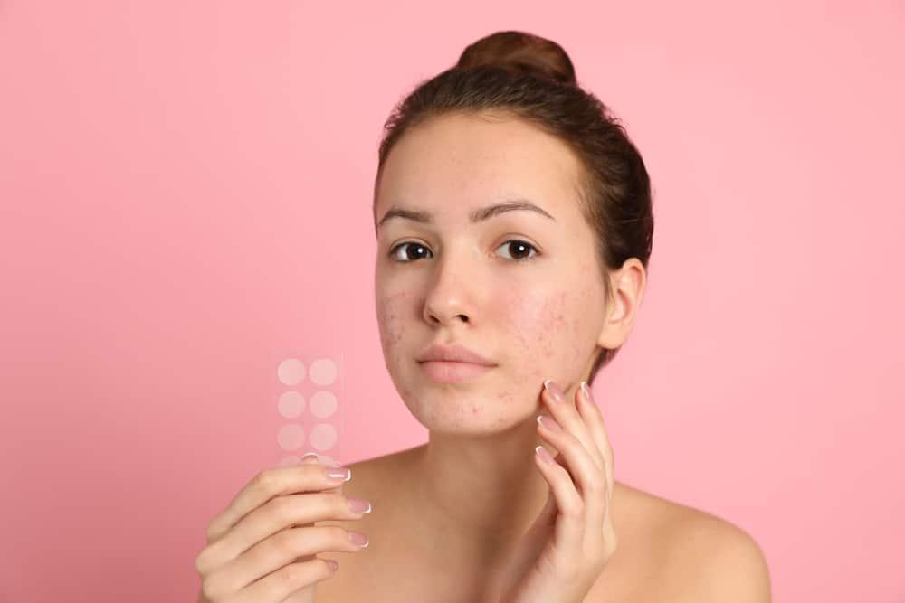 Tips Menggunakan Acne Patch Agar Jerawat Lebih Cepat Sembuh