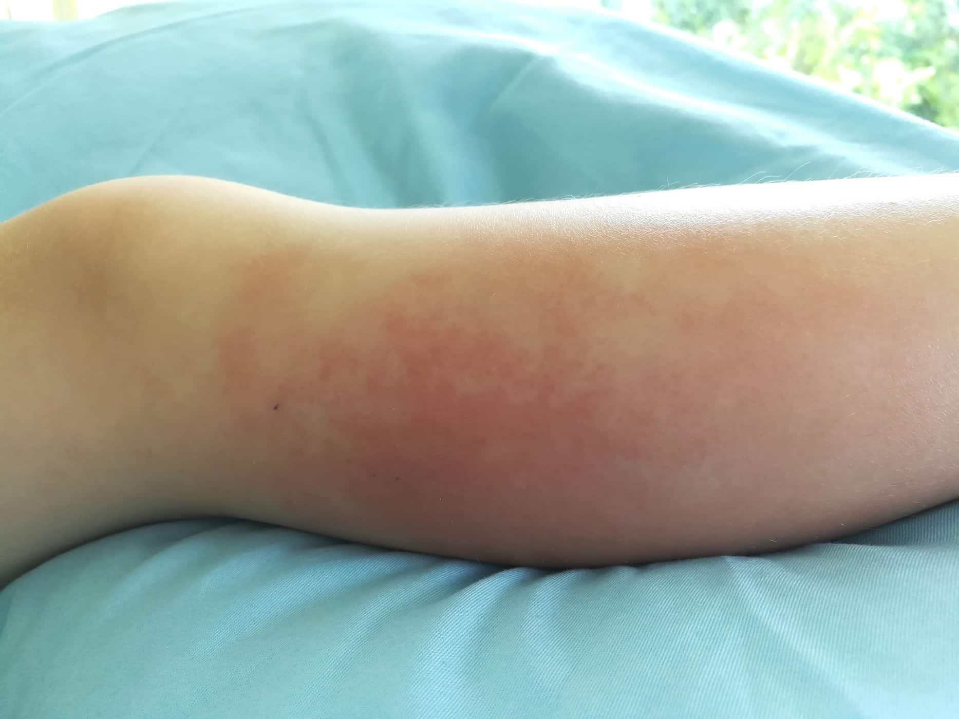 selulitis-pada-anak