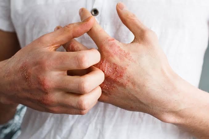 macam-macam-dermatitis