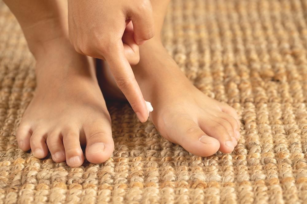 obat-untuk-mengatasi-infeksi-jamur-kulit