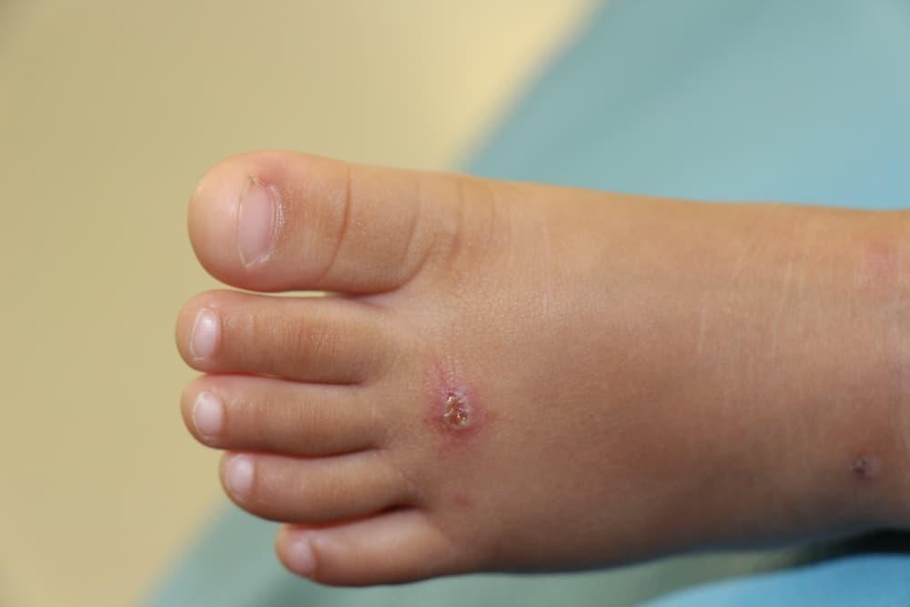 covid-toes-lesi-kaki