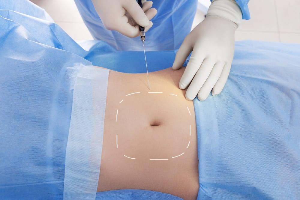 laser-lipolysis-adalah