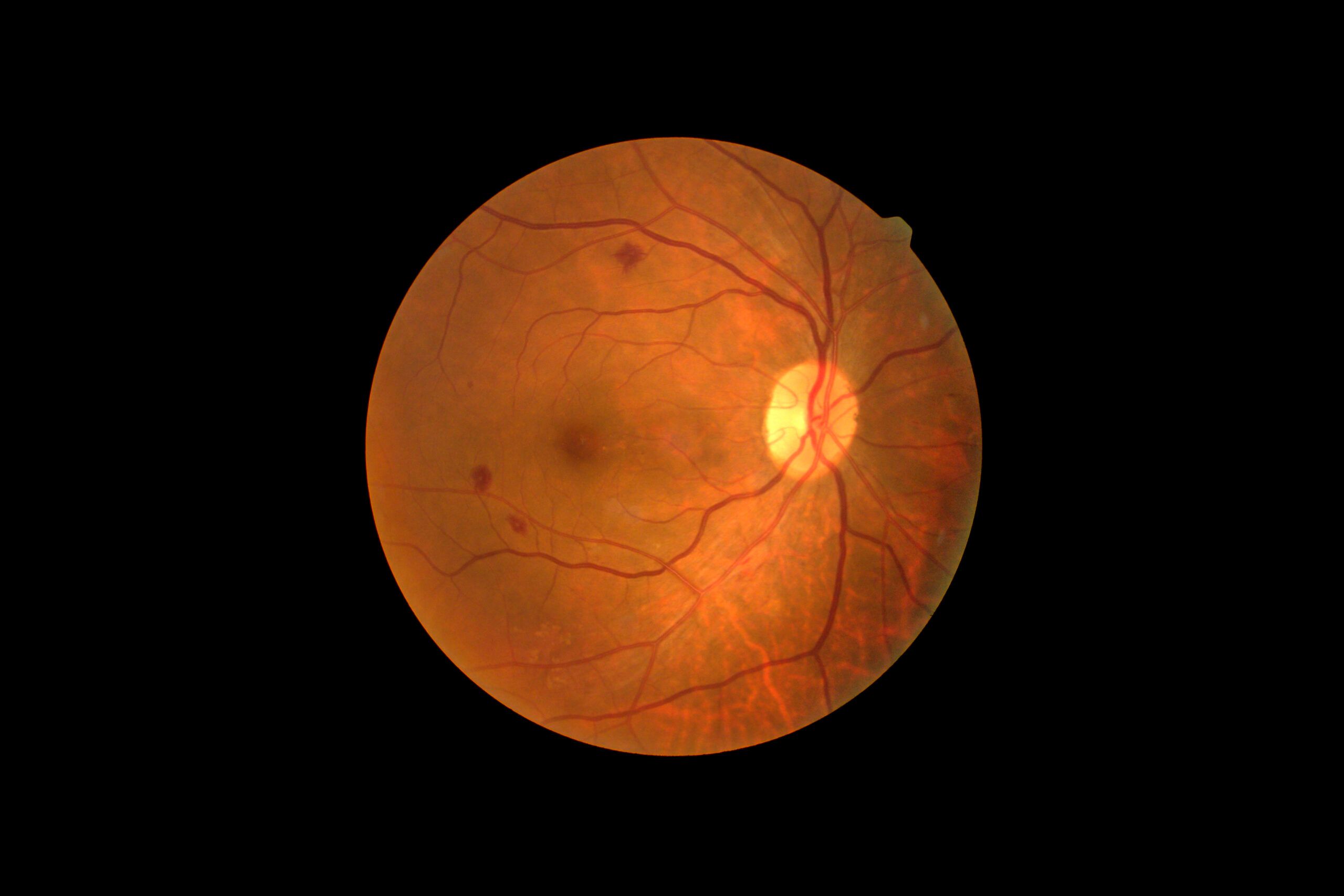 Retinopati Diabetik