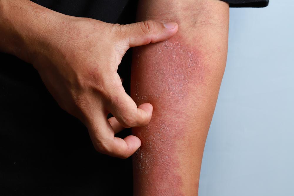 pengertian-dermatitis