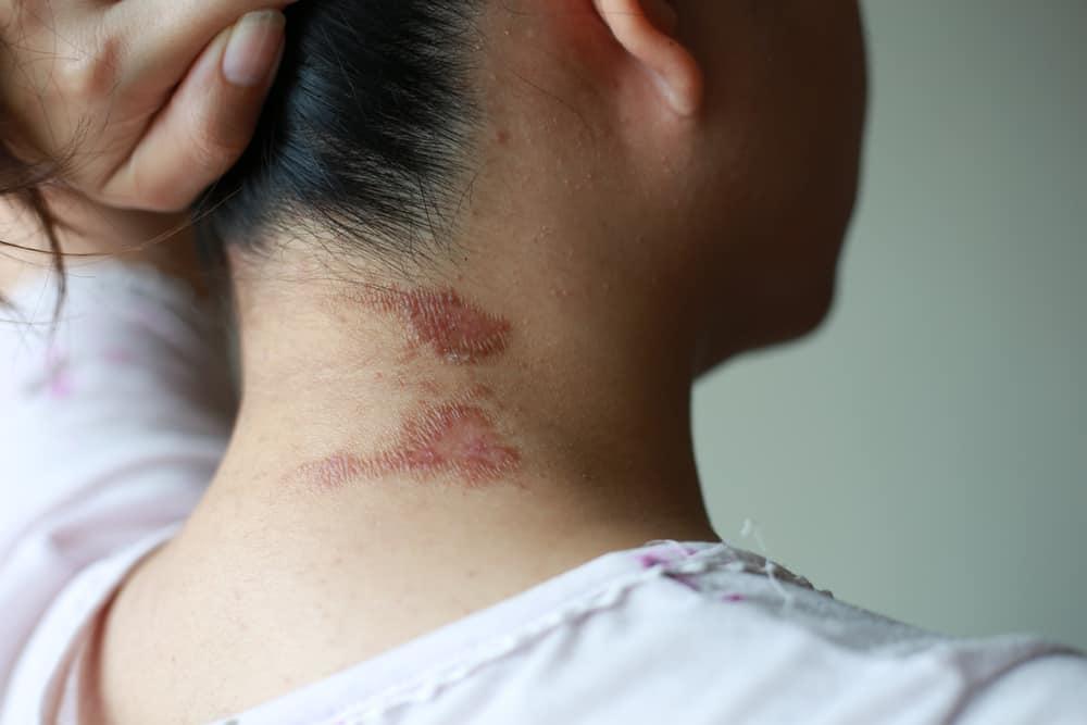 Dermatitis Venenata, Penyakit Kulit Akibat Gigitan Tomcat
