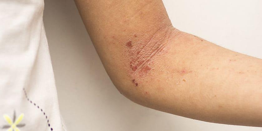 Dermatitis Intertriginosa (Intertrigo)