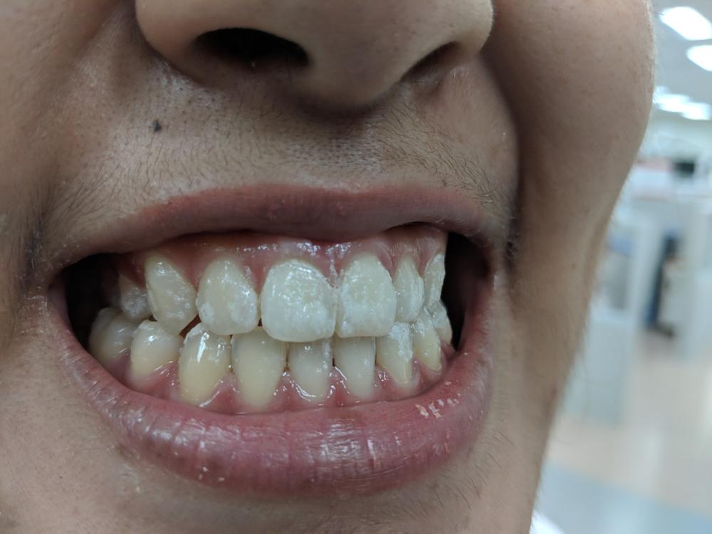 fluorosis