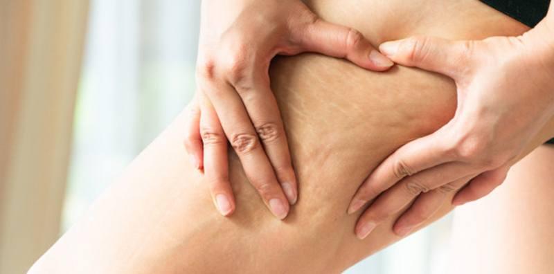 cara-menghilangkan-selulit