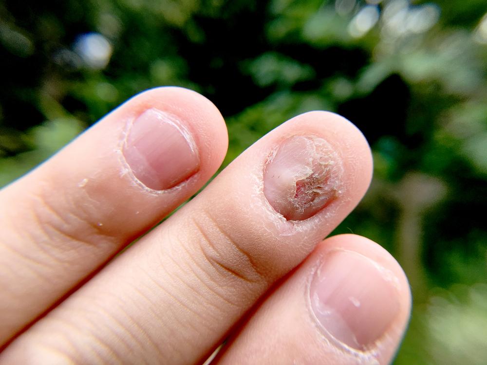 Jamur Kuku (Tinea Unguium)