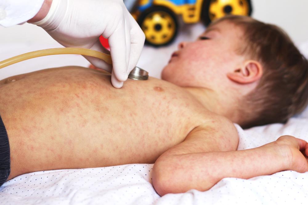 rubella