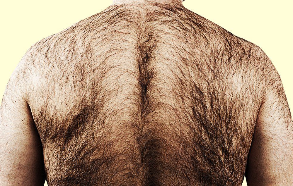 hypertrichosis-tumbuh-rambut-lebat