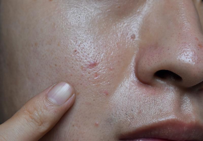 menghilangkan-sel-kulit-mati-eksfoliasi