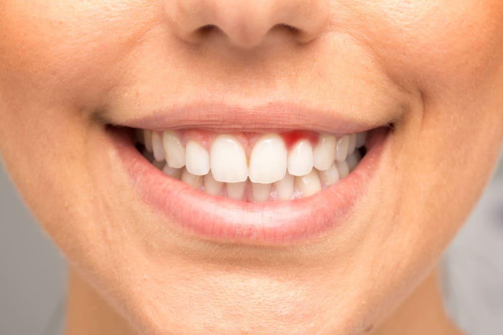 6 Vitamin dan Mineral Penting untuk Kesehatan Gigi dan Gusi