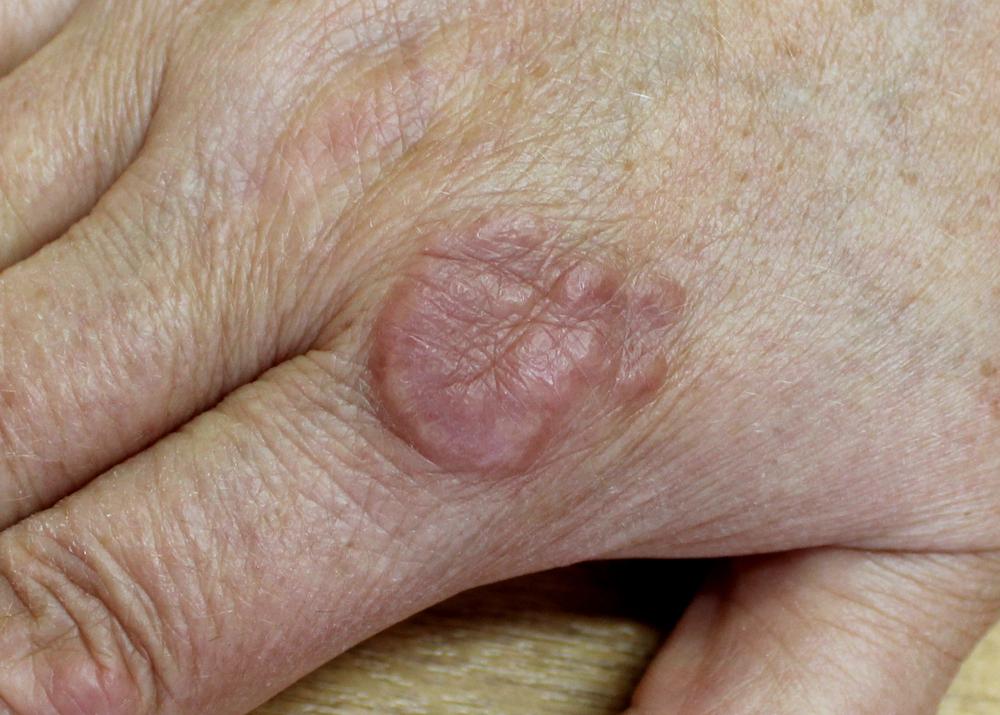 Granuloma Annulare