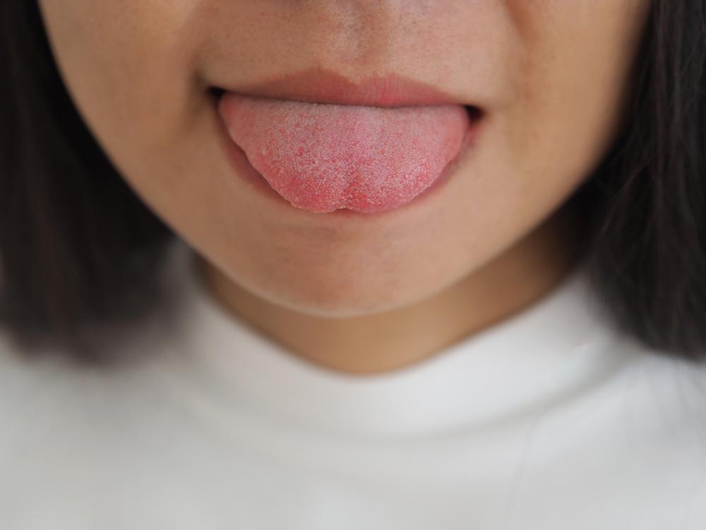 obat-sariawan-di-lidah