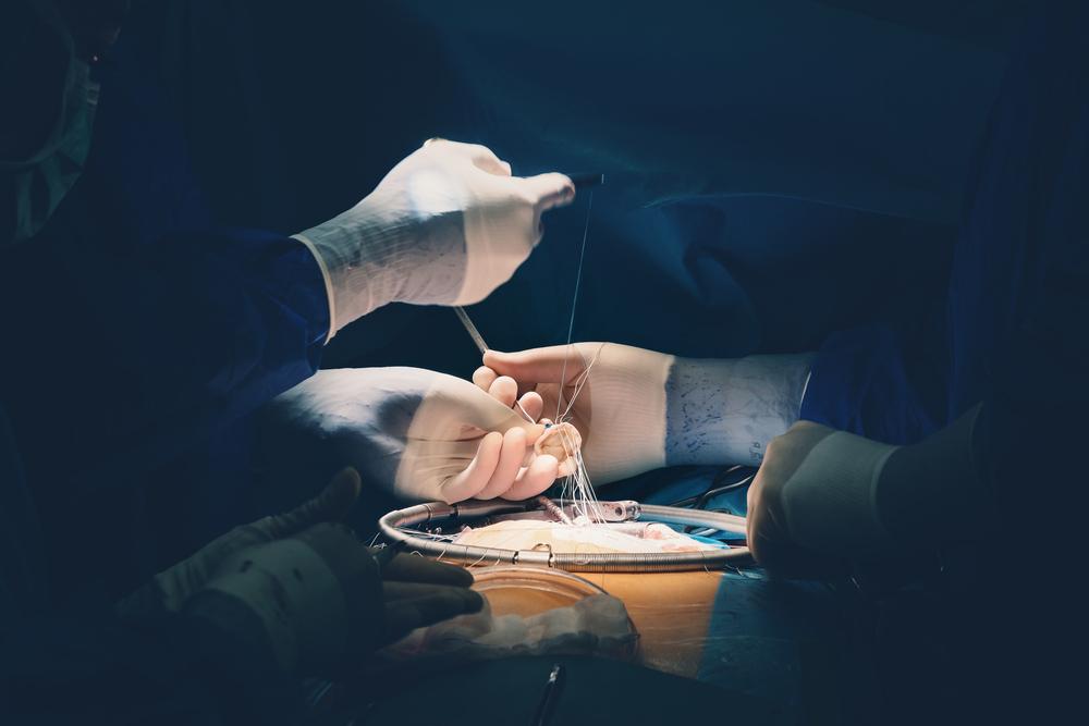 Mitral Valve Replacement (Operasi Penggantian Katup Mitral)