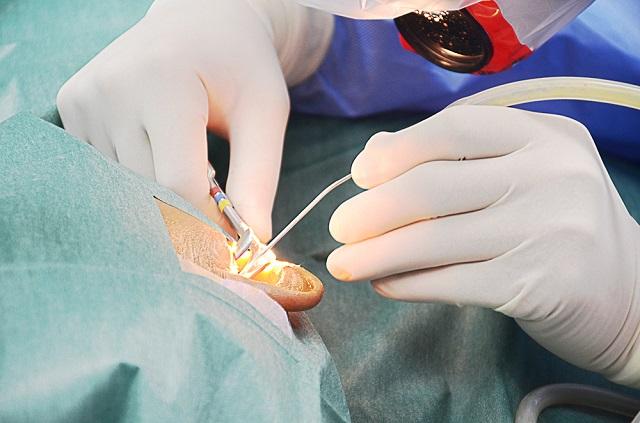 miringoplasti