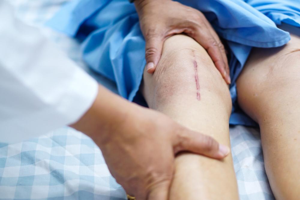 arthroplasty