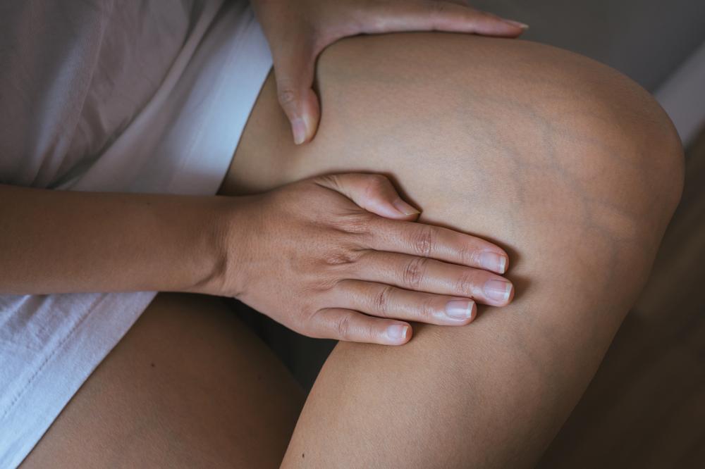 Varises saat Hamil, Pembuluh Darah Bengkak di Area Kaki dan Sekitarnya