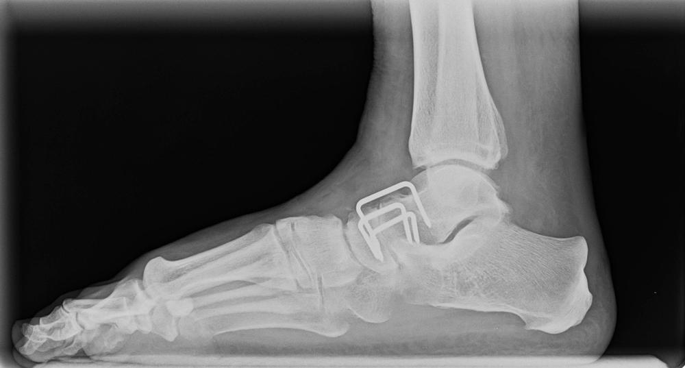 arthrodesis
