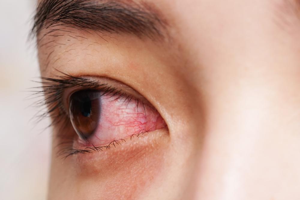 episkleritis