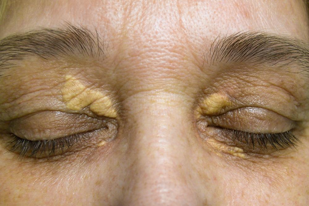 Xanthoma, Gumpalan Lemak di Kulit Akibat Kolesterol Tinggi