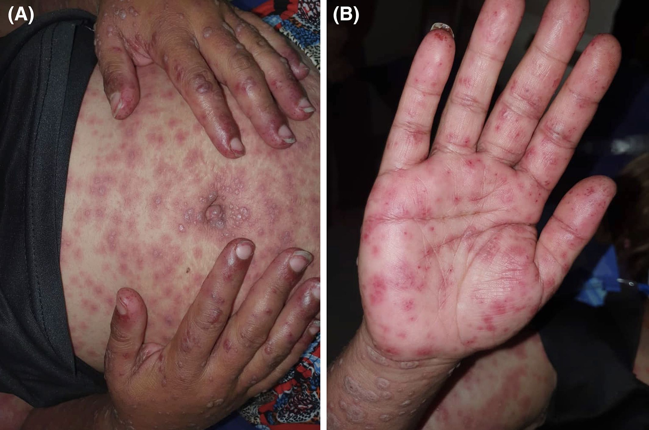 pengalaman-steven-johnson-syndrome