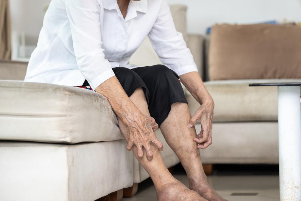 Dermopati Diabetik, Munculnya Bercak pada Kaki Akibat Diabetes