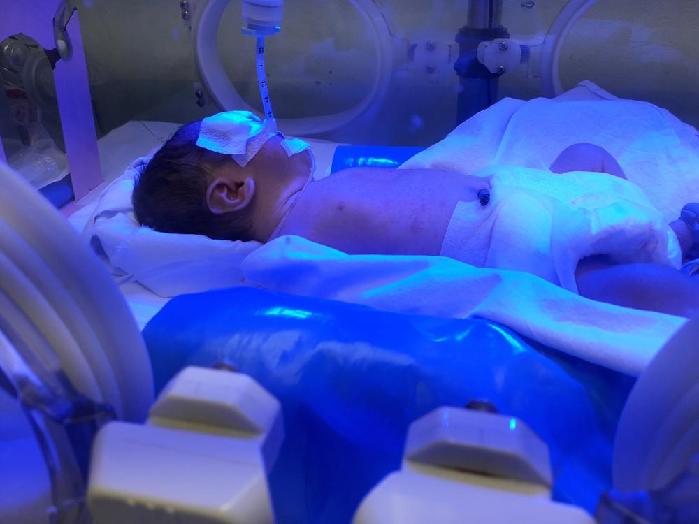 Mengenal Kadar Bilirubin Normal pada Bayi Baru Lahir